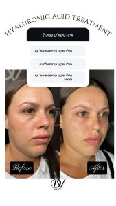 פיסול פנים בקריית אונו